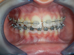 Ortho11